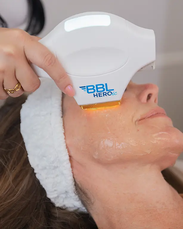 woman-receiving-bbl-treatment-at-splendid-skin-medspa