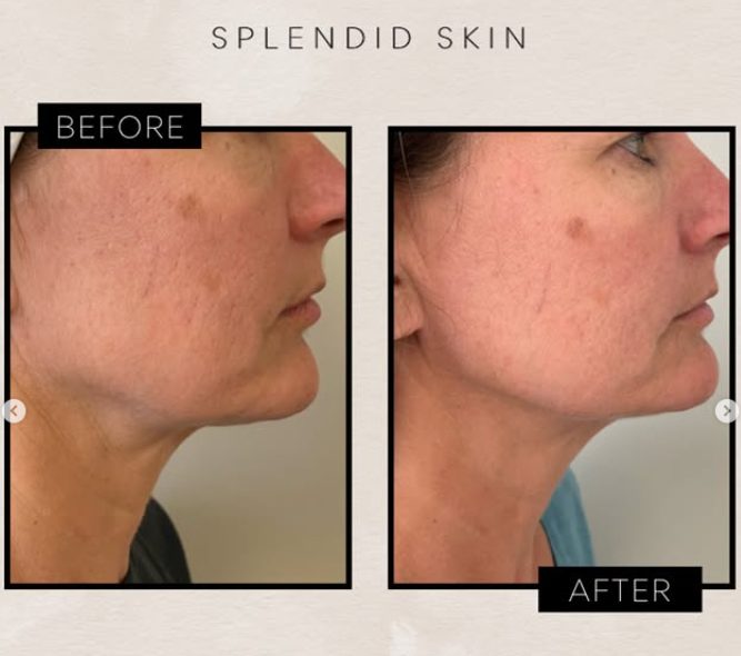 Before and after photo of Sofwave skin tightening on the neck and jawline at Splendid Skin in Franklin, TN