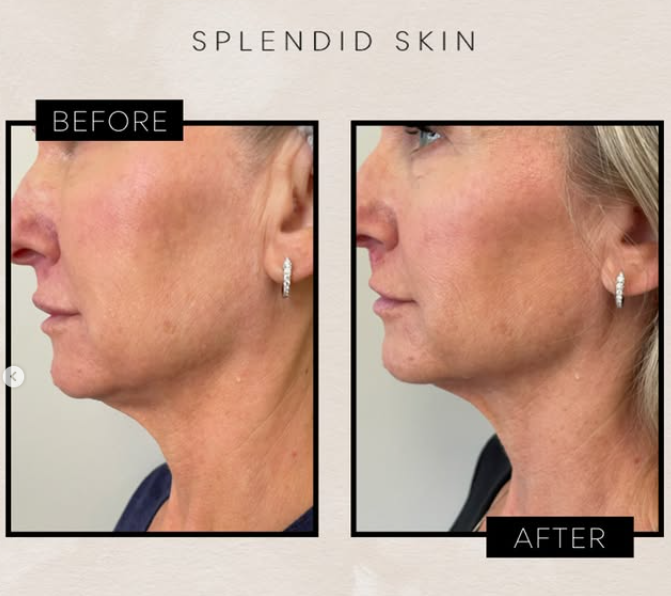 Sofwave non-invasive skin tightening results for submental laxity, Splendid Skin medspa Franklin TN