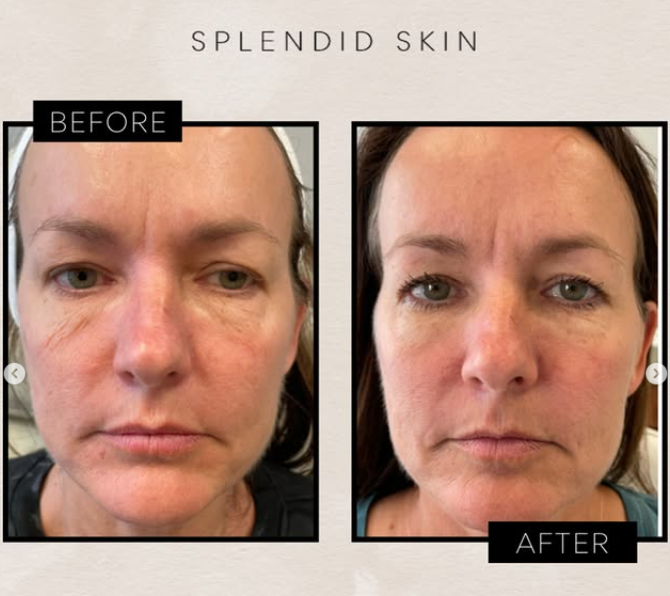 Before and after Sofwave treatment for upper arm skin laxity by Jennifer Golin RN, Splendid Skin Franklin TN